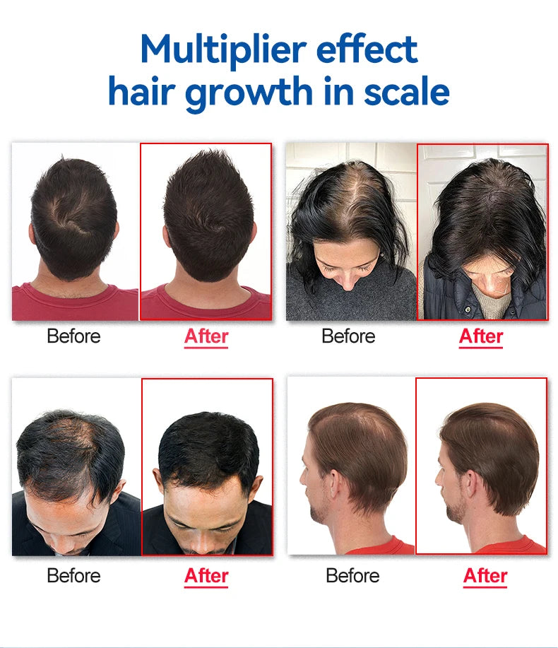 LLLT Hair Regrowth Helmet